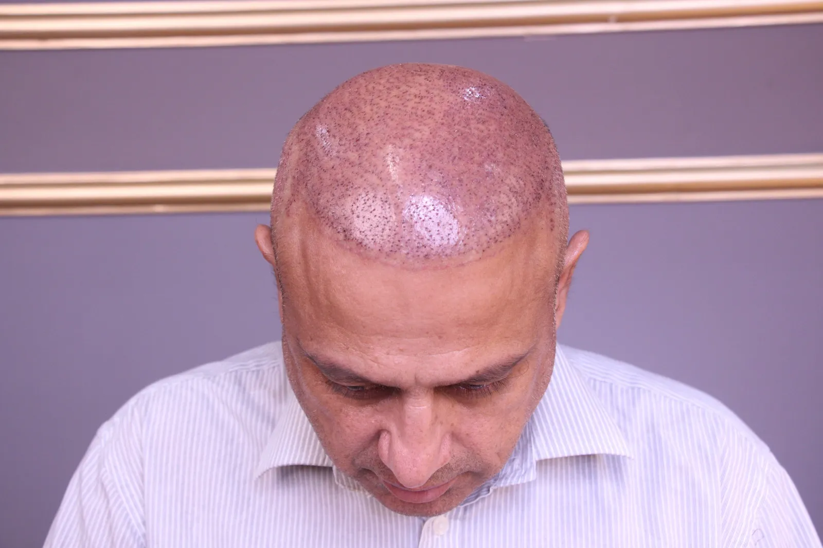 Hair Transplant Cost – Is It Worth the Investment?