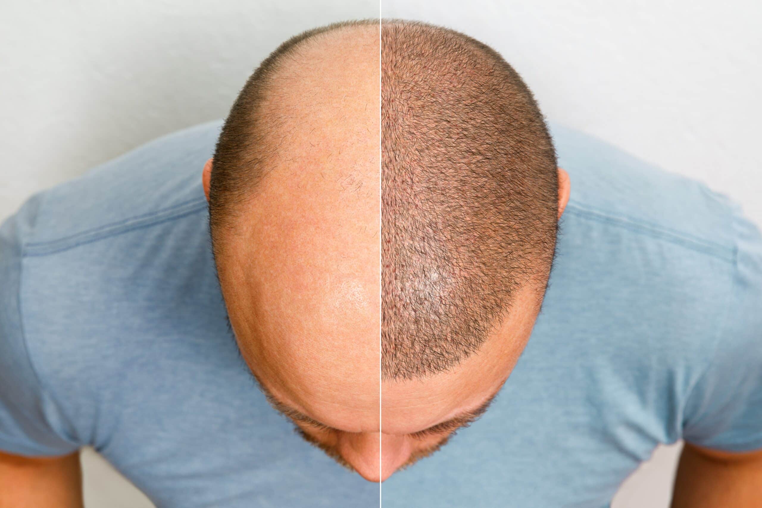 Hair Transplant UK Experts: Trusted Nationwide for Excellence